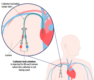 Diagram illustrating the human heart and its valves, highlighting the catheter lock solution and it's function.